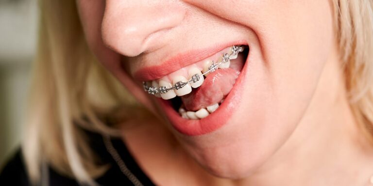 Metal Braces